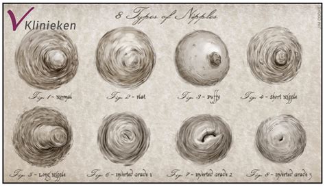 Areola Abnormalities